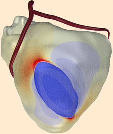 extracellular potentials on a model of the human
              ventricles, computed by propag